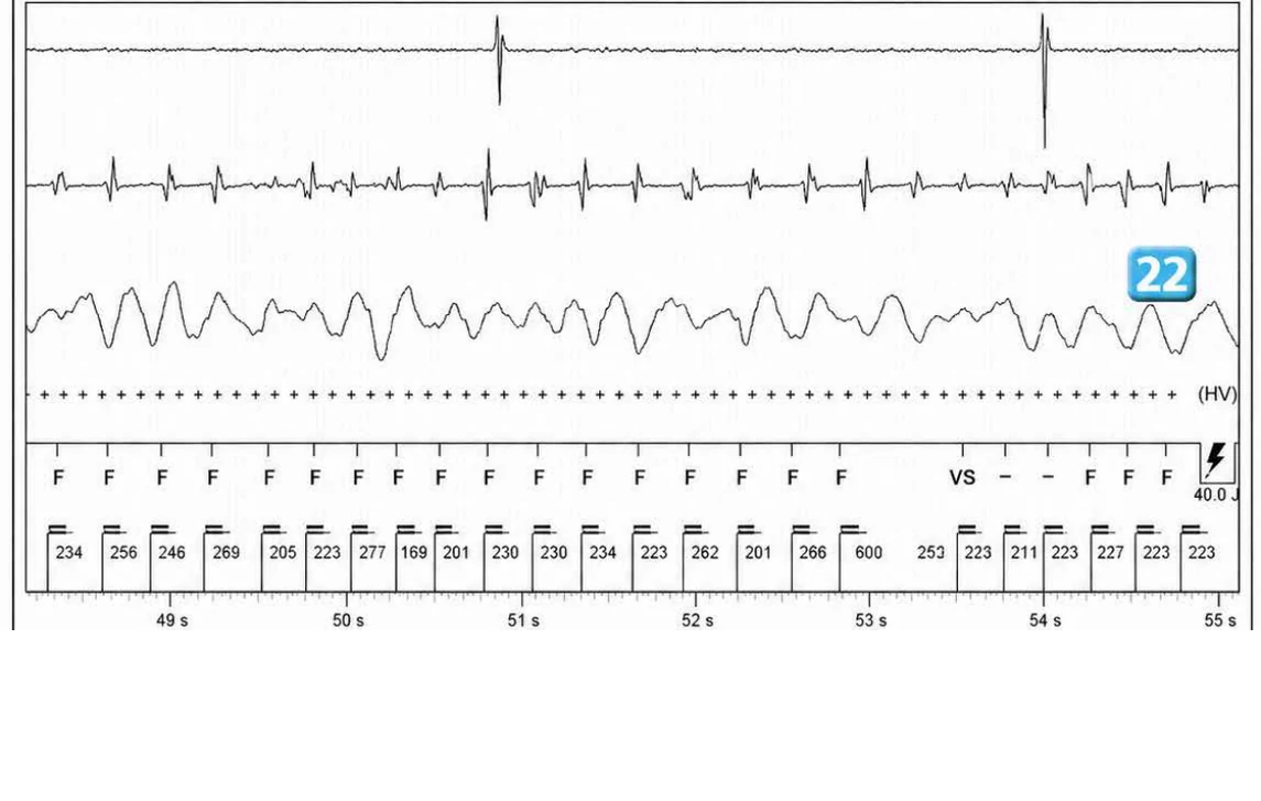 Abbott ICD electrogram, segment 26 of 29 — Acceleration of VT by anti-tachycardia pacing and high defibrillation threshold