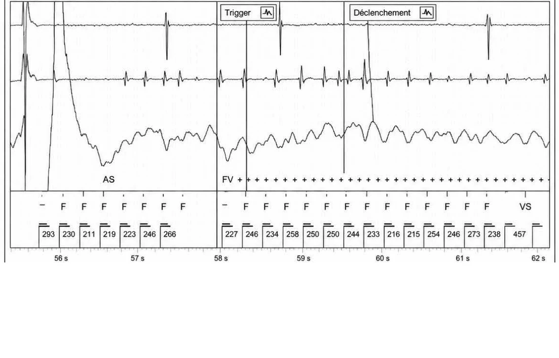 Abbott ICD electrogram, segment 27 of 29 — Acceleration of VT by anti-tachycardia pacing and high defibrillation threshold