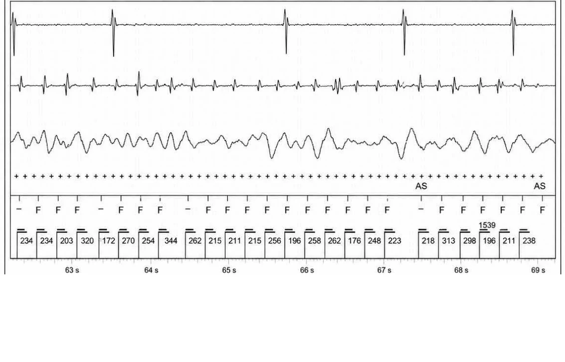 Abbott ICD electrogram, segment 28 of 29 — Acceleration of VT by anti-tachycardia pacing and high defibrillation threshold