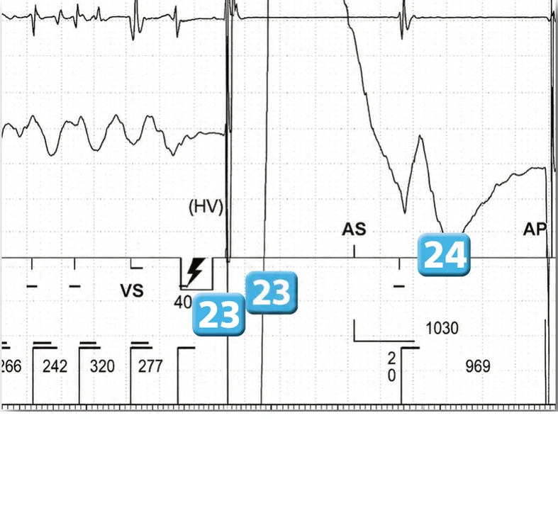 Abbott ICD electrogram, segment 29 of 29 — Acceleration of VT by anti-tachycardia pacing and high defibrillation threshold