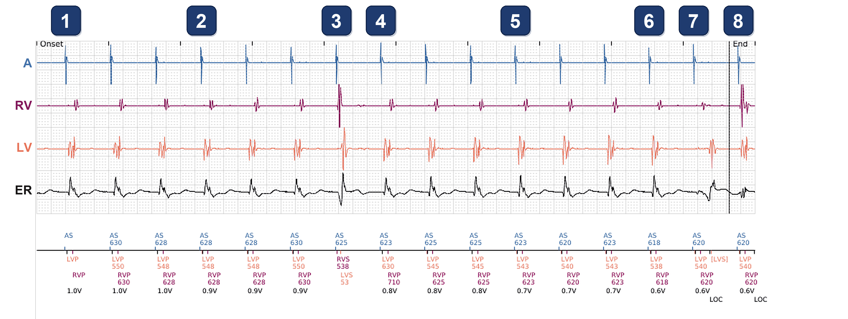 Boston Scientific CRT electrogram, segment 1/1 — PaceSafe LV test with an unexpected beat