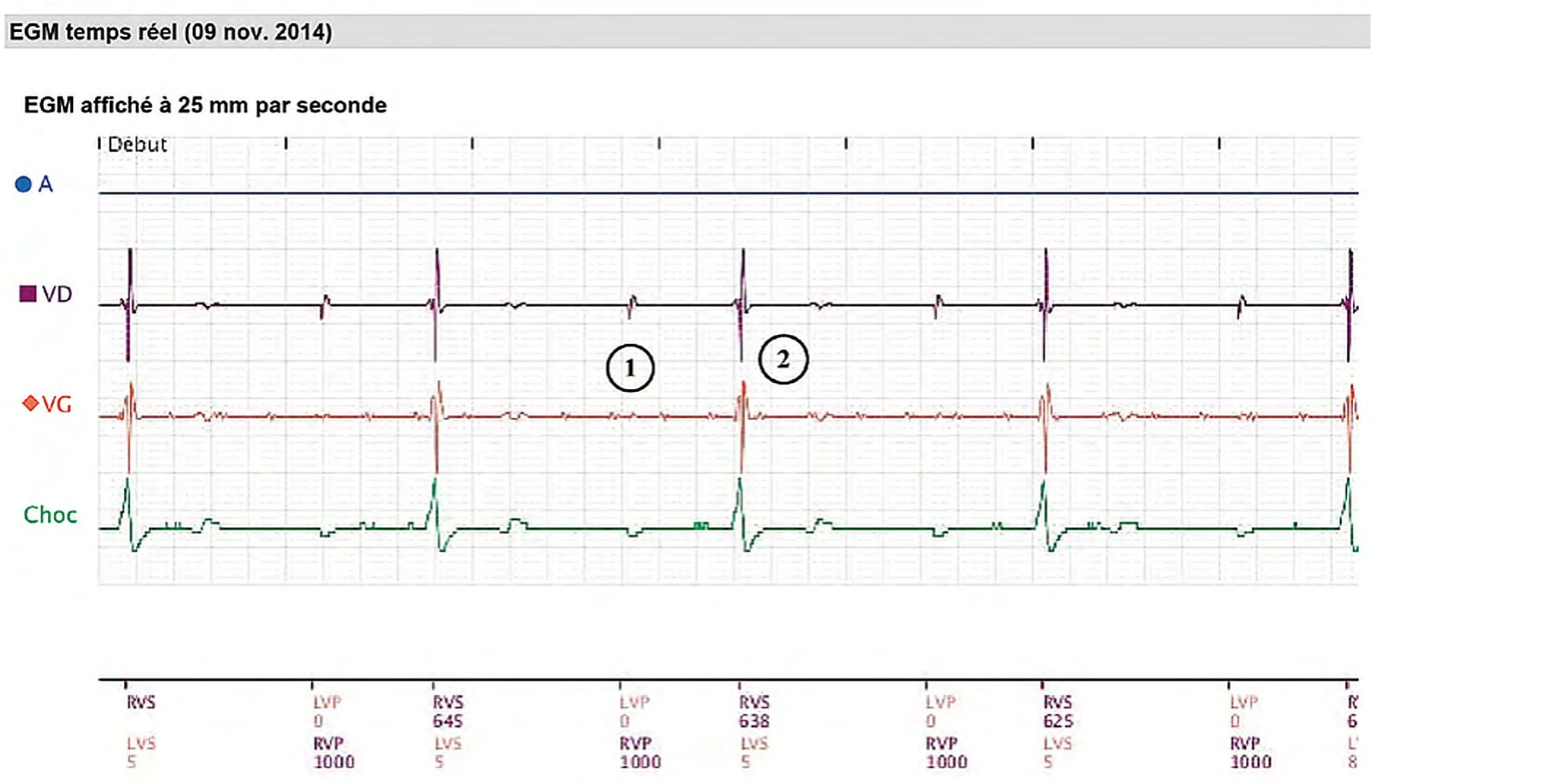 Boston Scientific CRT electrogram, segment 1/8 — Remote real-time EGM in a dialysis patient
