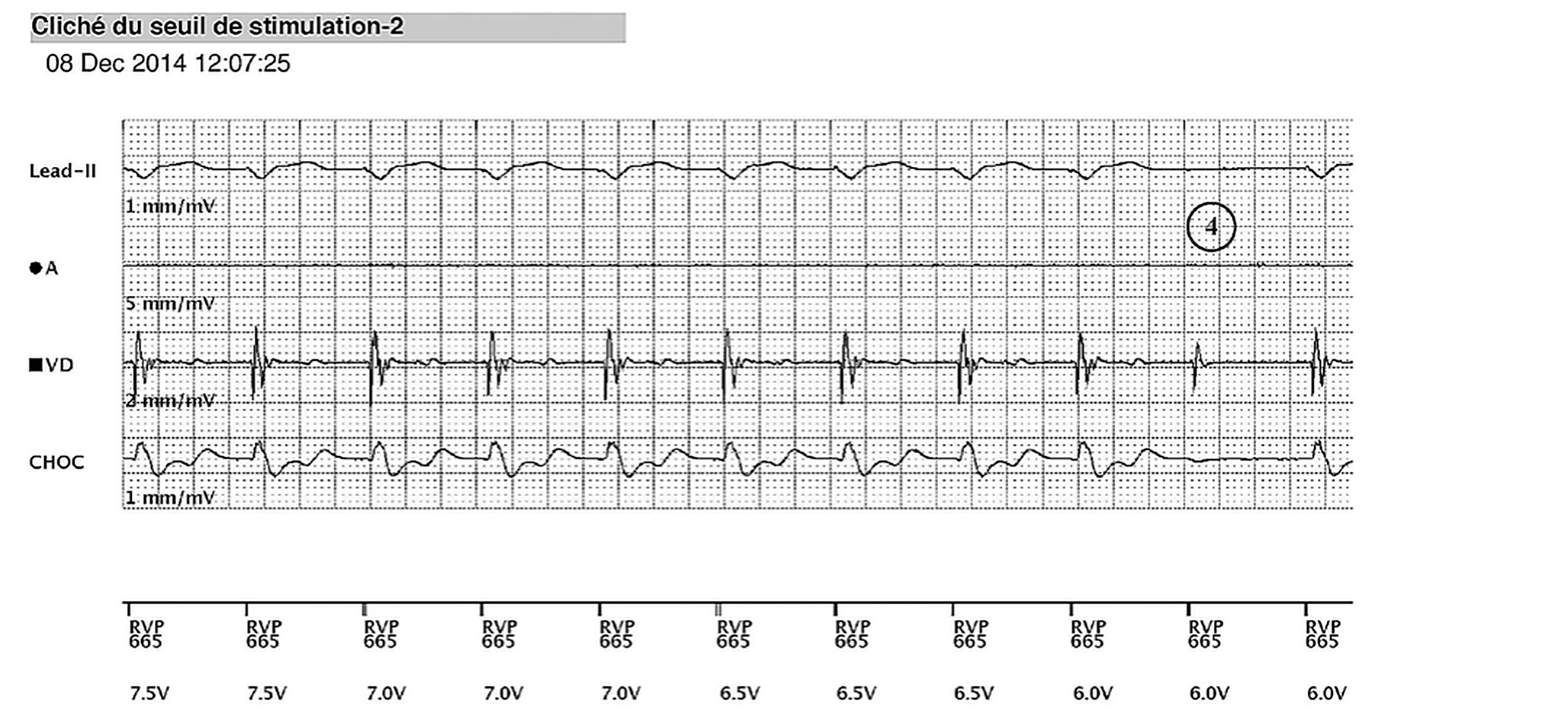 Boston Scientific CRT electrogram, segment 4/8 — Remote real-time EGM in a dialysis patient