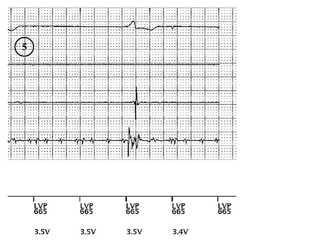 Boston Scientific CRT electrogram, segment 6/8 — Remote real-time EGM in a dialysis patient