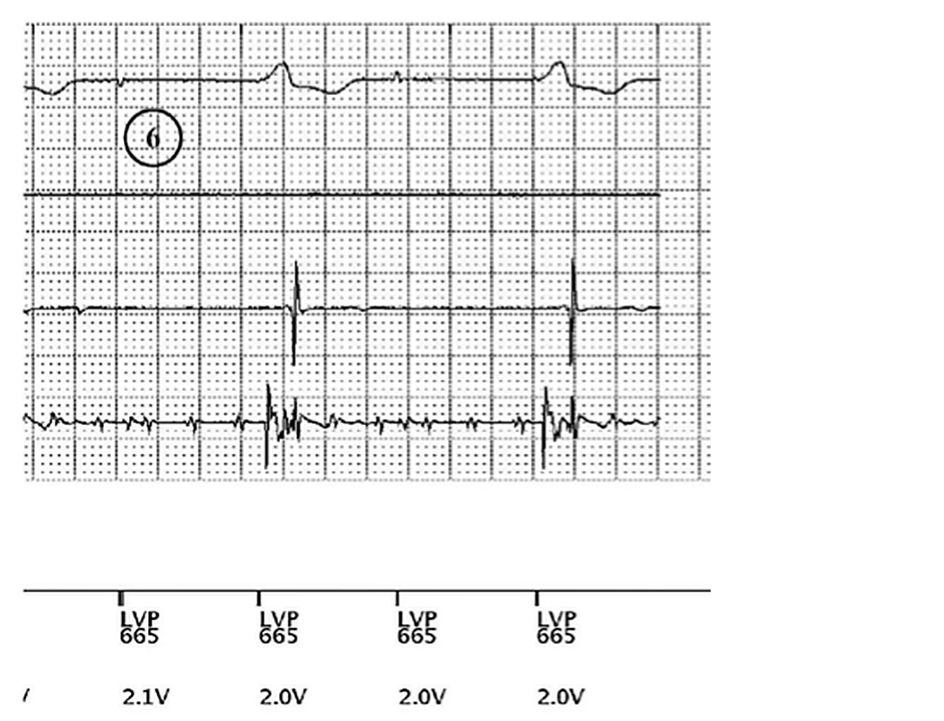 Boston Scientific CRT electrogram, segment 8/8 — Remote real-time EGM in a dialysis patient