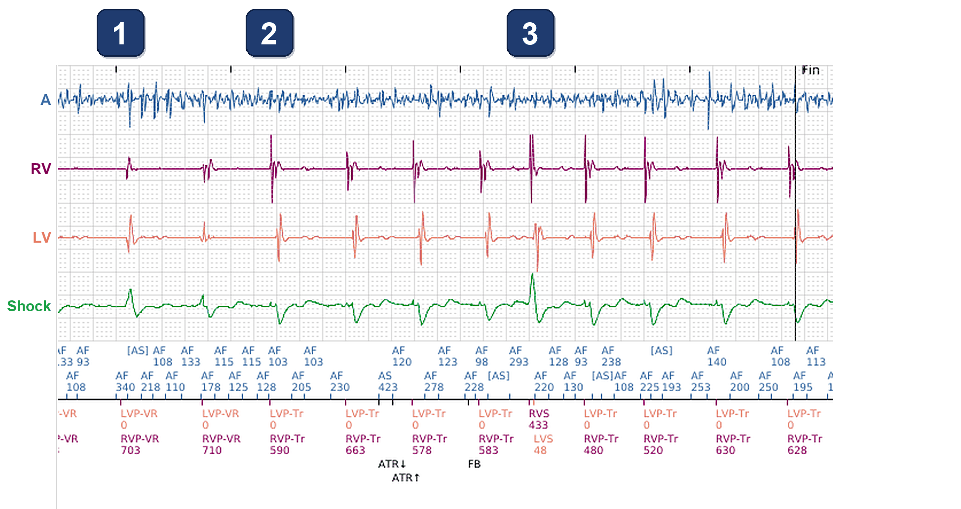 Boston Scientific CRT electrogram, segment 1/5 — BiV Trigger in AF, and the same patient 15 months later