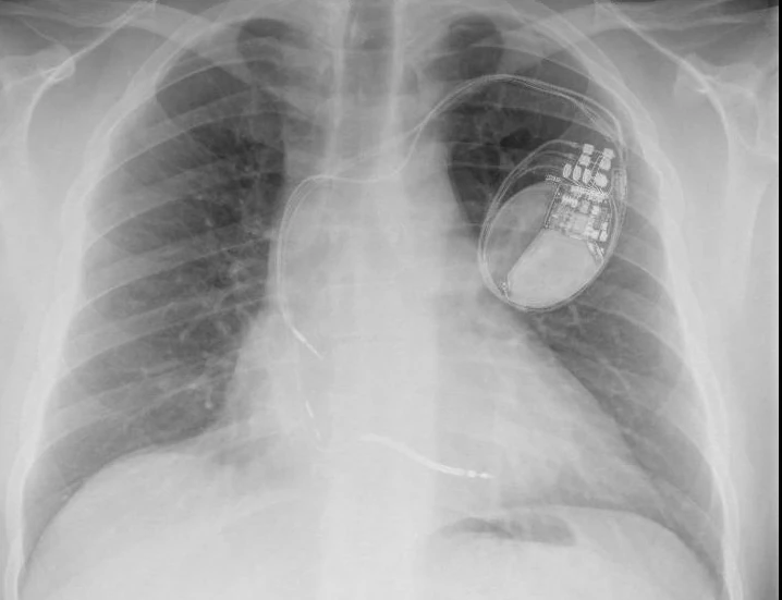 Chest X-ray shown with the case (frontal view): the CRT-D and its three leads, atrial, RV defibrillation and the 3830 on the LV port; the 3830 is the middle, thin one