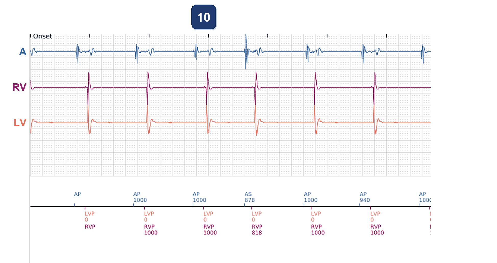 Boston Scientific CRT electrogram, segment 7/7 — LV impedance out-of-range alert near battery end of life