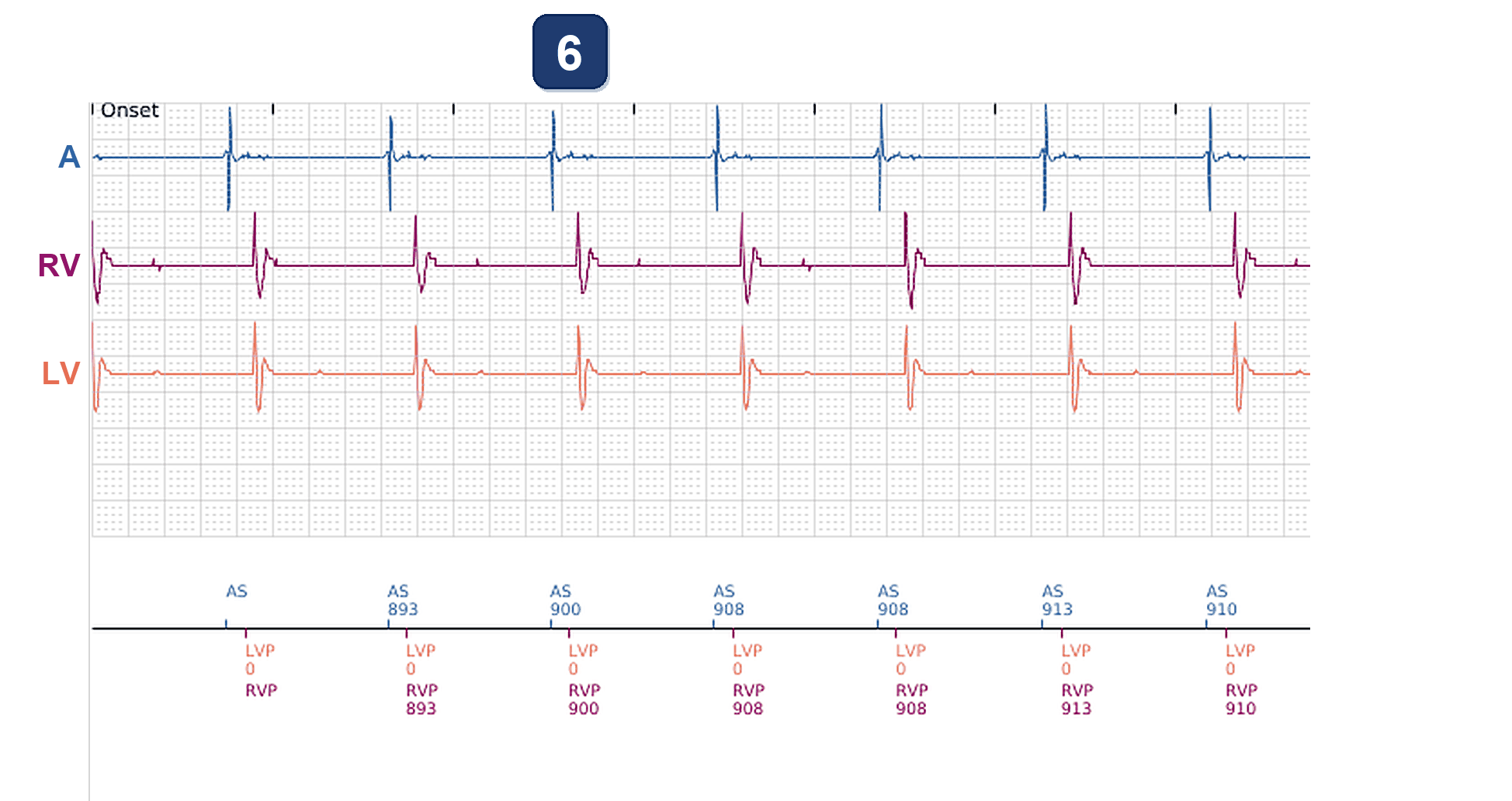 Boston Scientific CRT electrogram, segment 3/7 — LV impedance jump after an office visit