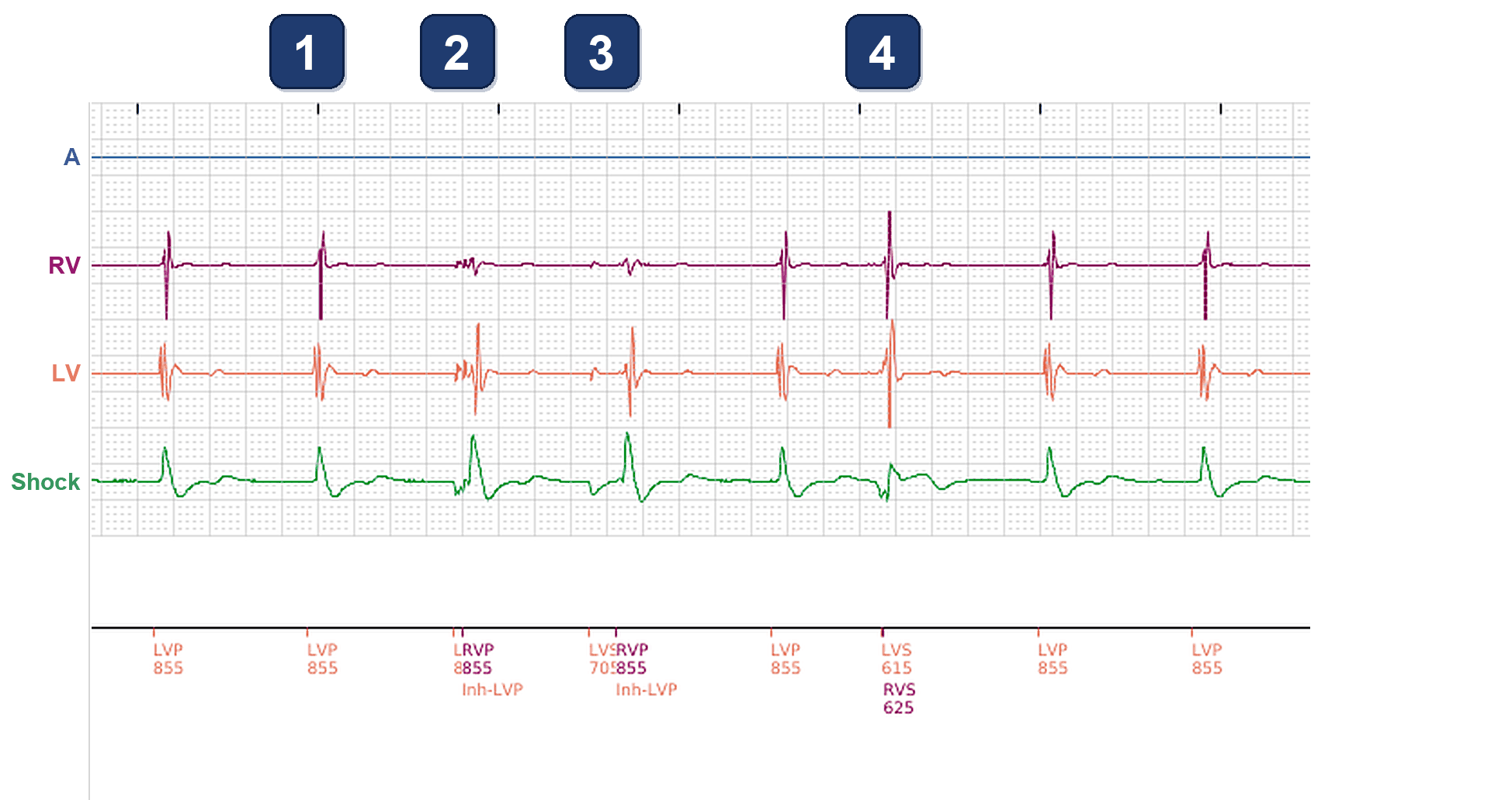 Boston Scientific CRT electrogram, segment 1/3 — LV-only pacing with oversensing on the LV and on the RV channel