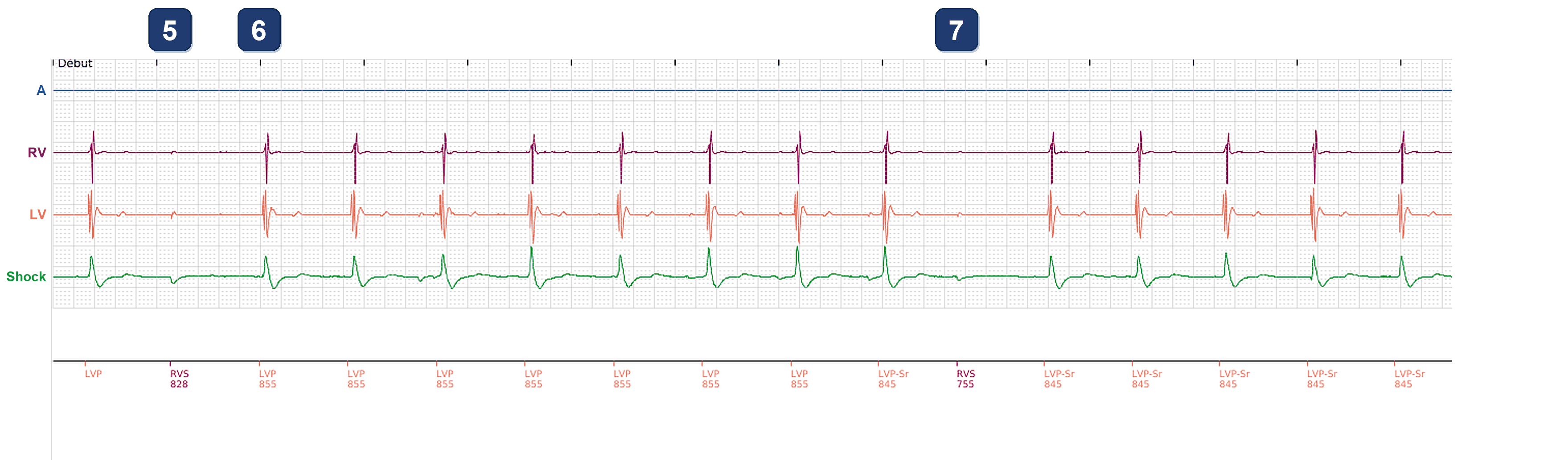 Boston Scientific CRT electrogram, segment 3/3 — LV-only pacing with oversensing on the LV and on the RV channel