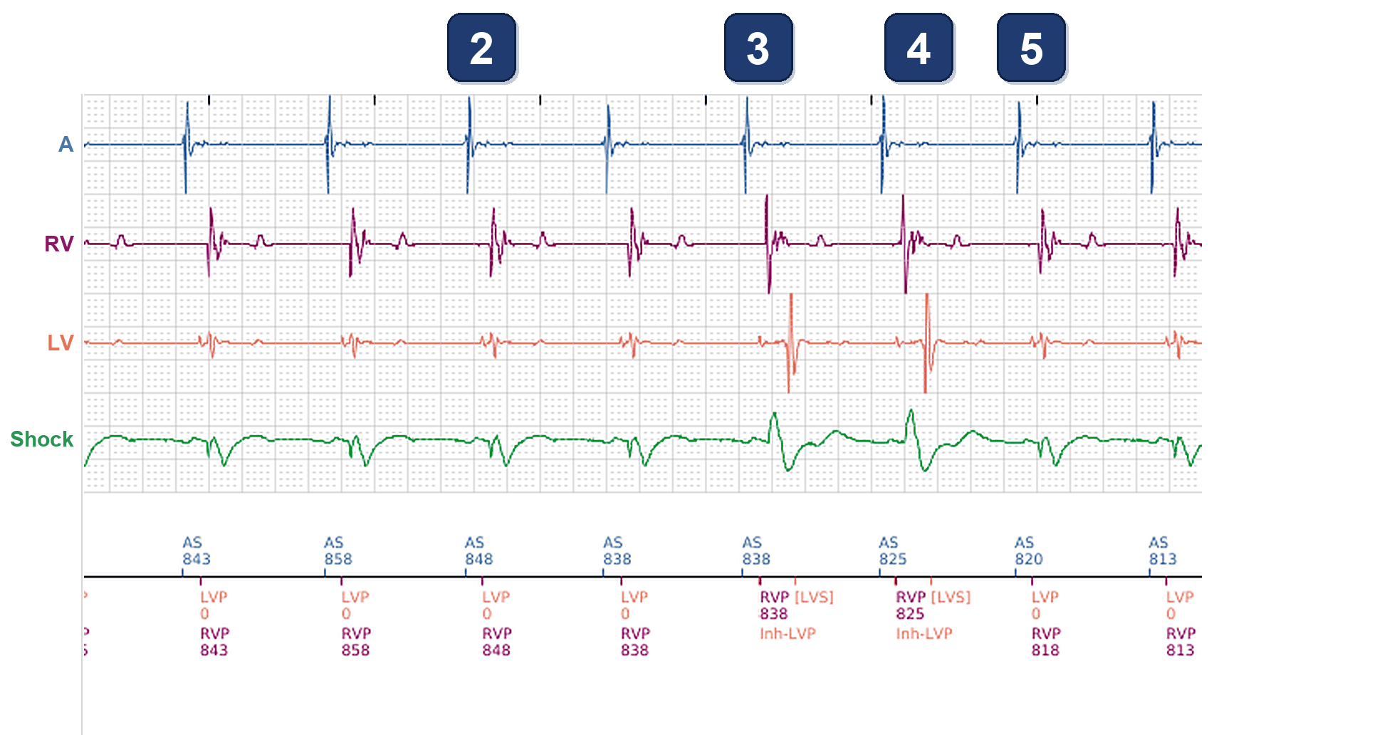 Boston Scientific CRT electrogram, segment 2/3 — Intermittent loss of LV pacing despite 99% RV pacing