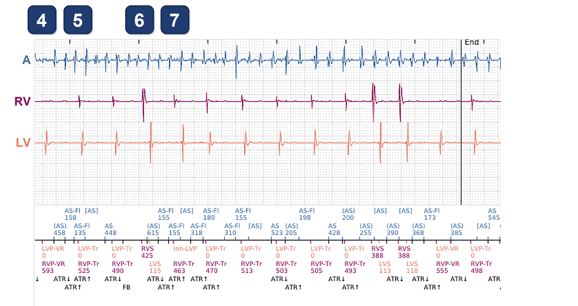 Boston Scientific CRT electrogram, segment 2/5 — CRT-P in AF: two different pacing percentages