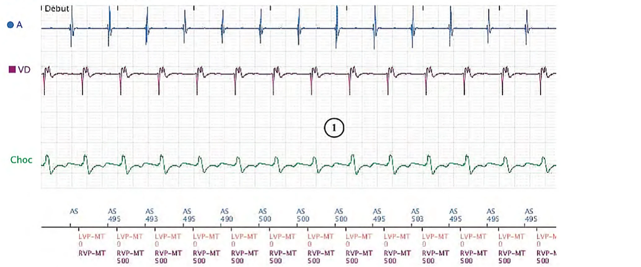 Boston Scientific CRT electrogram, segment 1/8 — Sinus tachycardia, Wenckebach and pro-arrhythmia
