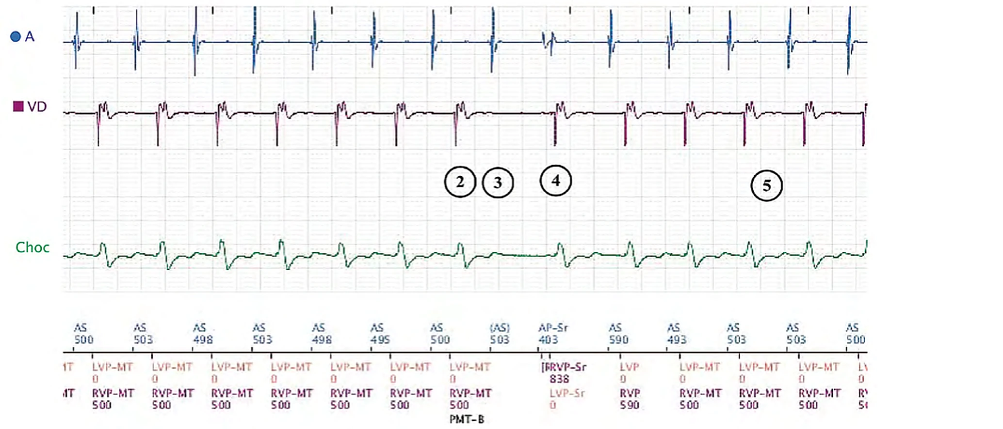 Boston Scientific CRT electrogram, segment 2/8 — Sinus tachycardia, Wenckebach and pro-arrhythmia