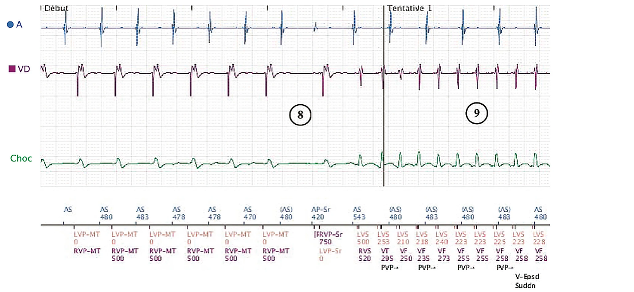 Boston Scientific CRT electrogram, segment 7/8 — Sinus tachycardia, Wenckebach and pro-arrhythmia