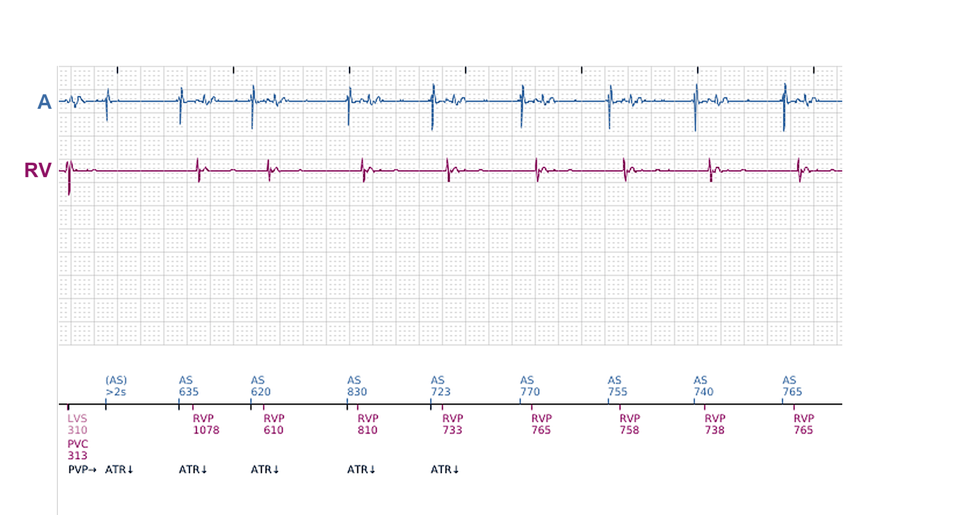 Boston Scientific CRT electrogram, segment 10/11 — Ventricular episodes in a CRT-P: what started them?