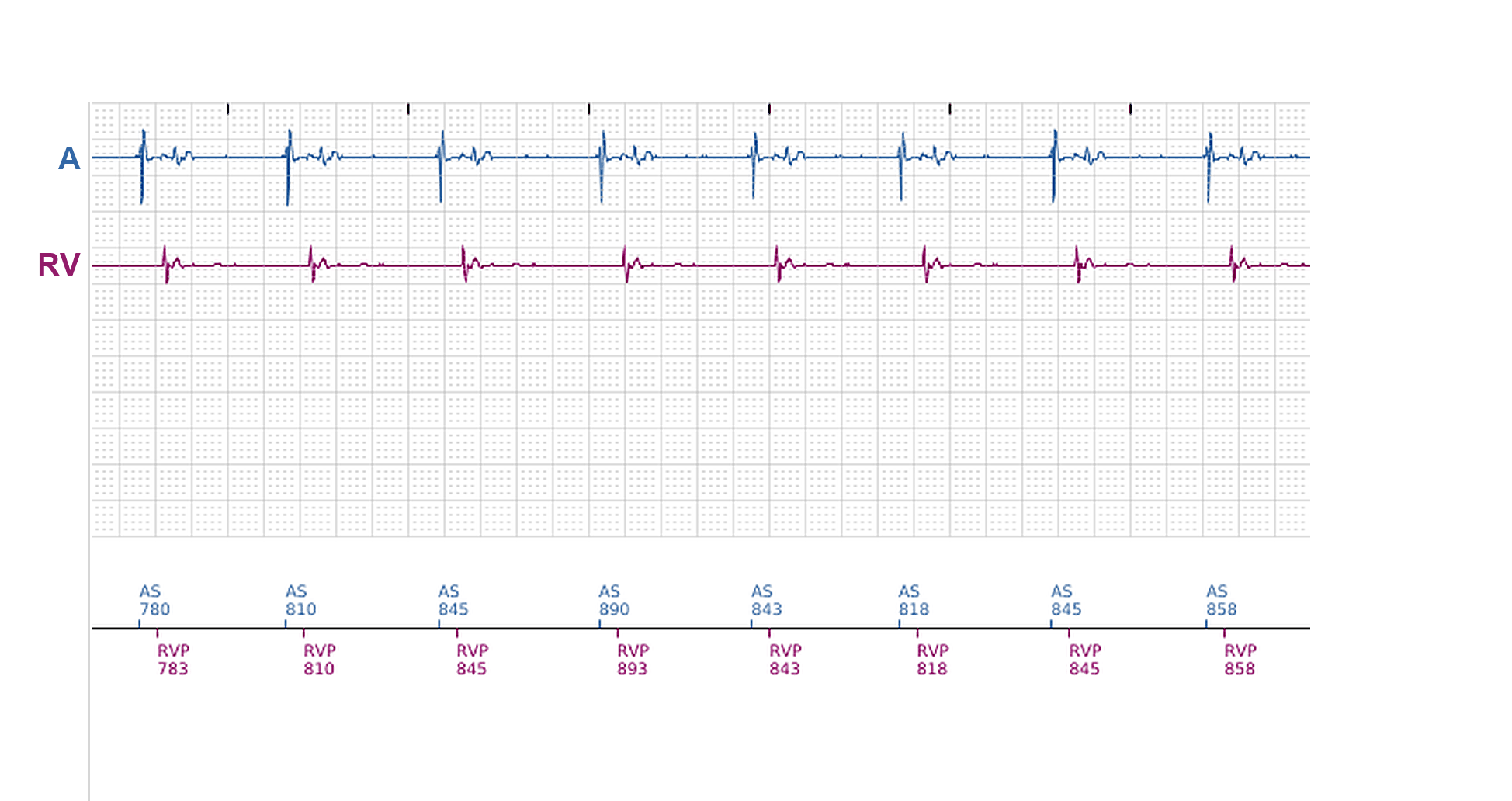 Boston Scientific CRT electrogram, segment 11/11 — Ventricular episodes in a CRT-P: what started them?