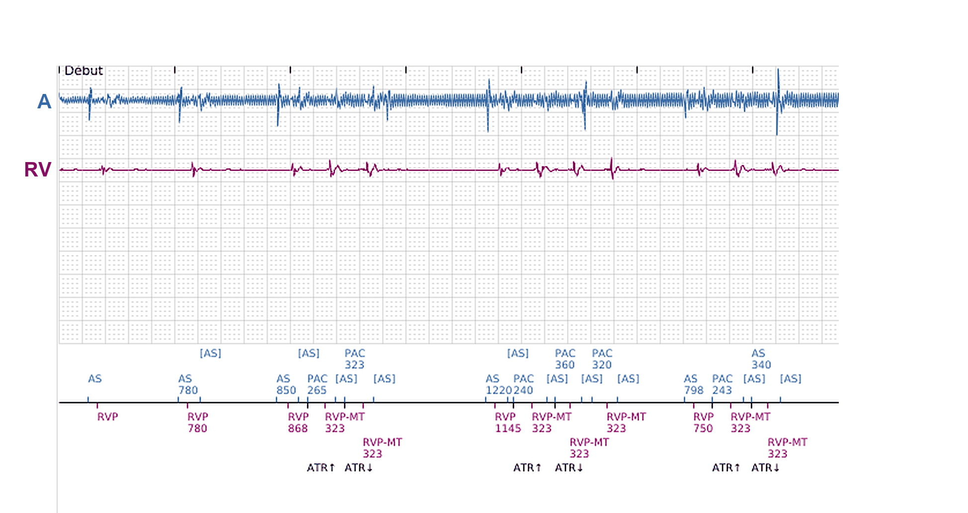 Boston Scientific CRT electrogram, segment 2/11 — Ventricular episodes in a CRT-P: what started them?