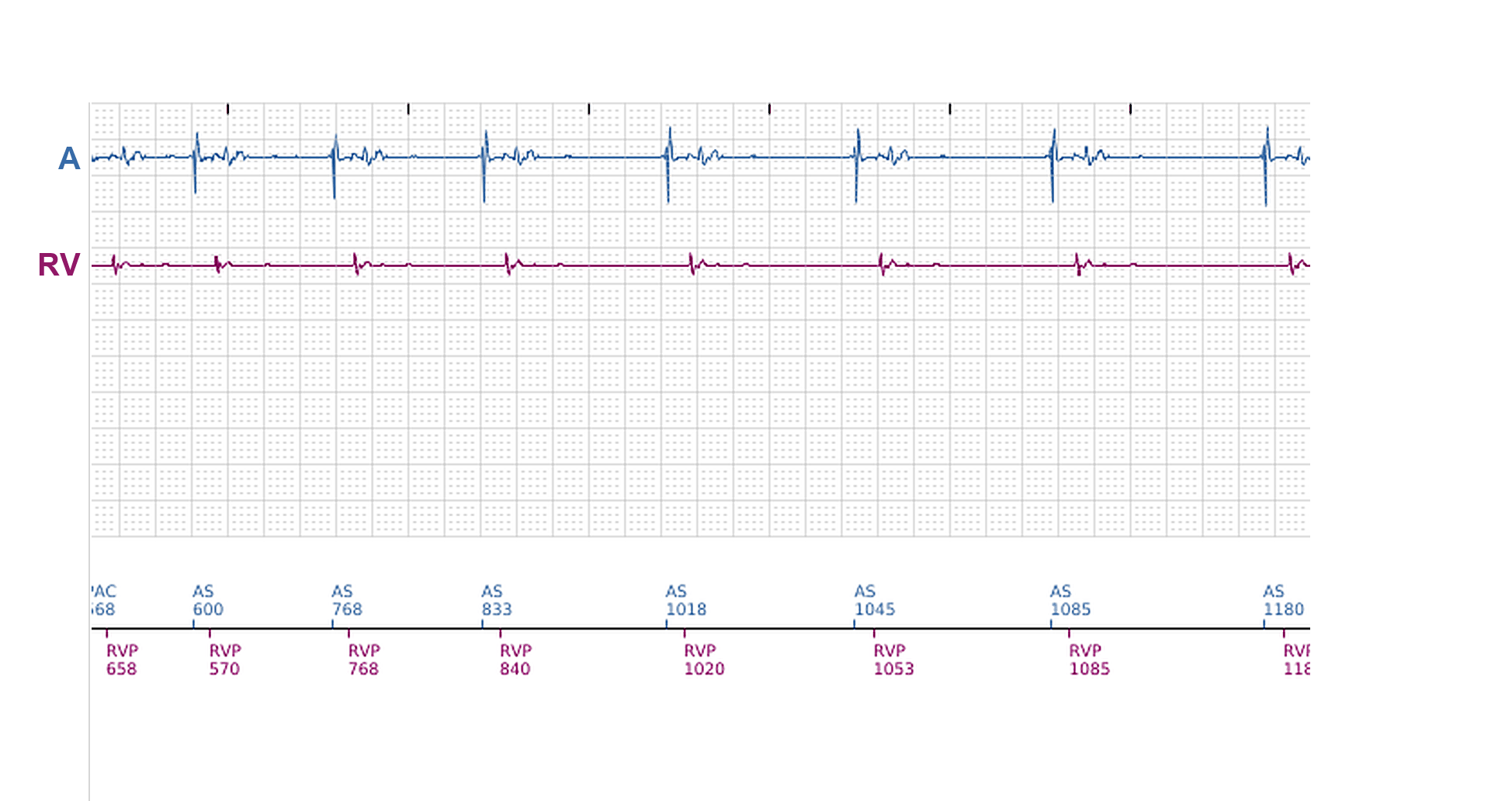 Boston Scientific CRT electrogram, segment 5/11 — Ventricular episodes in a CRT-P: what started them?
