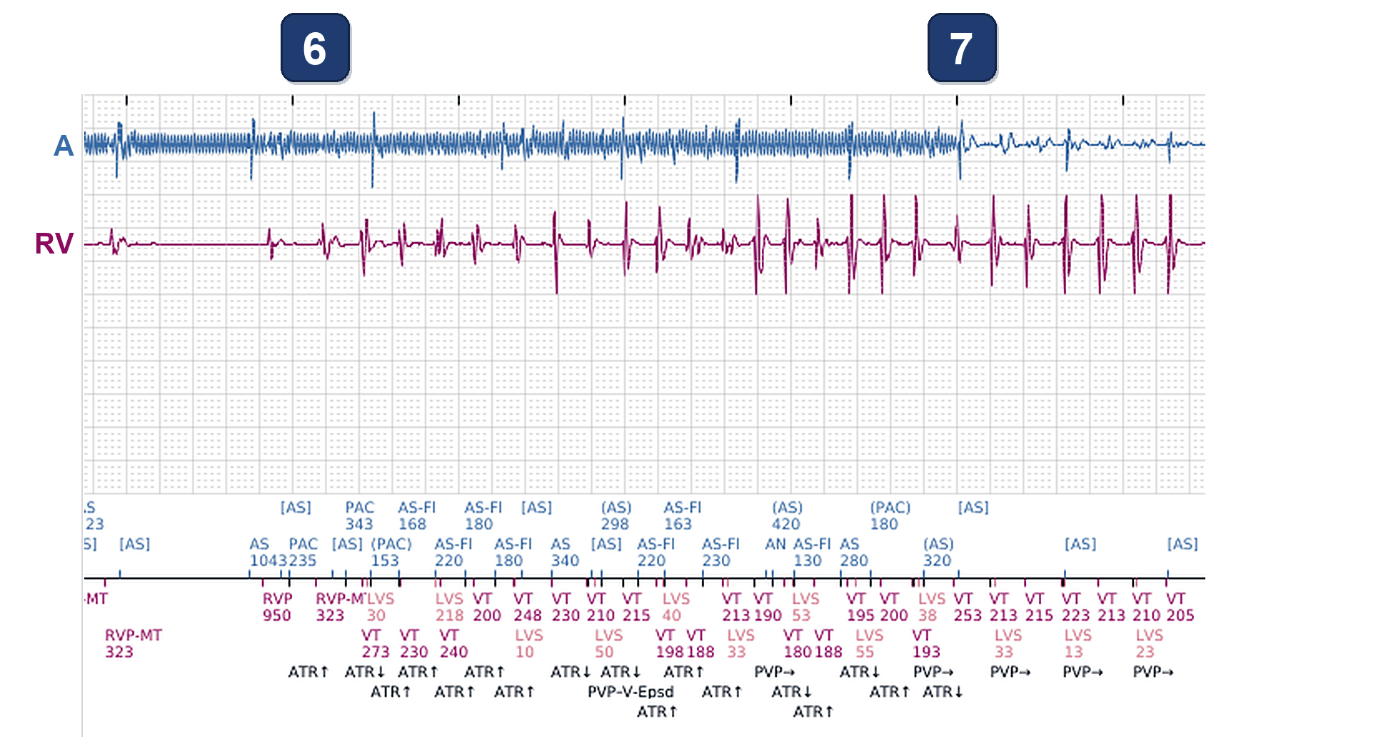 Boston Scientific CRT electrogram, segment 9/11 — Ventricular episodes in a CRT-P: what started them?