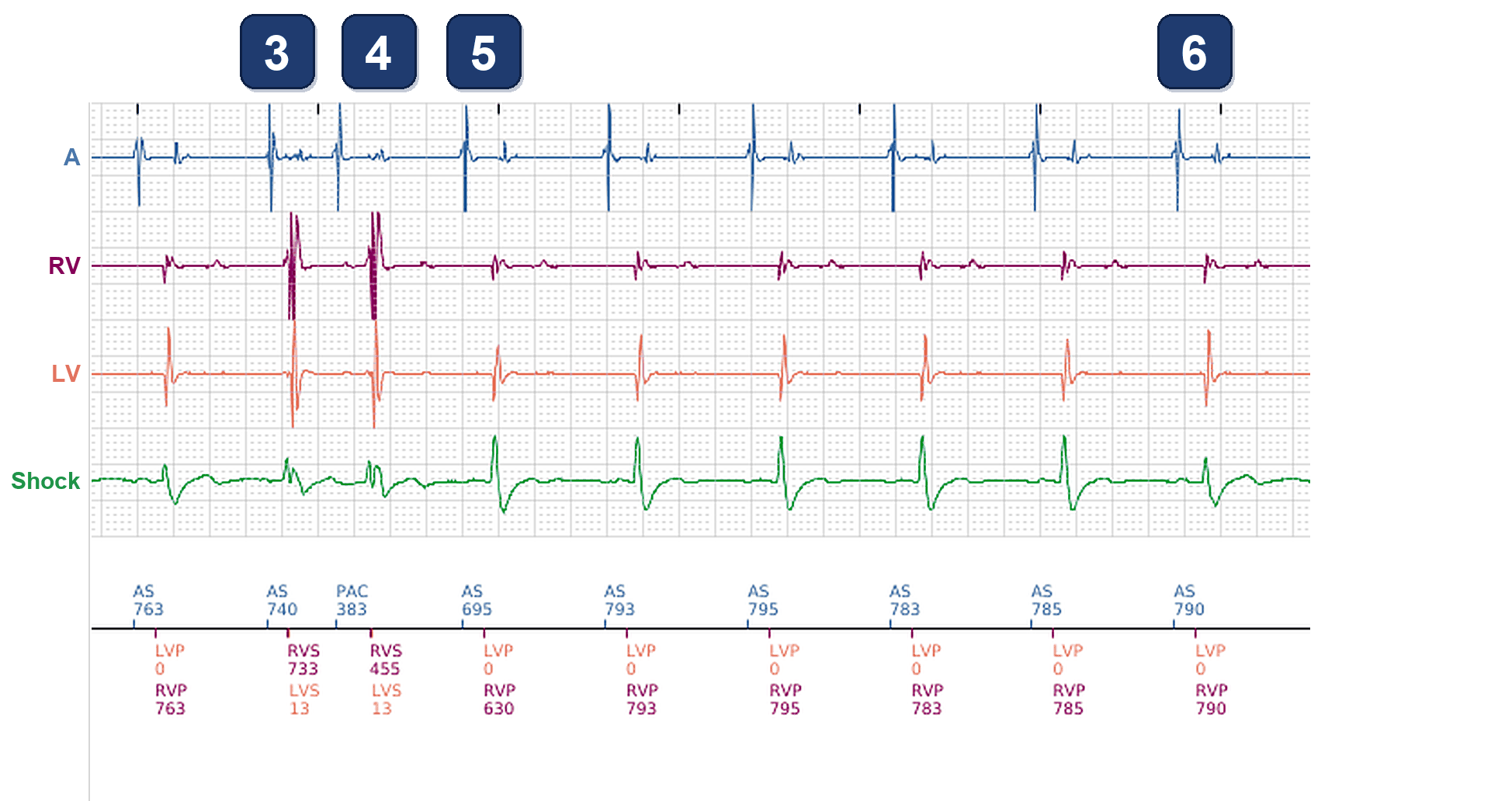 Boston Scientific CRT electrogram, segment 2/3 — BiV markers with changing far-field morphology