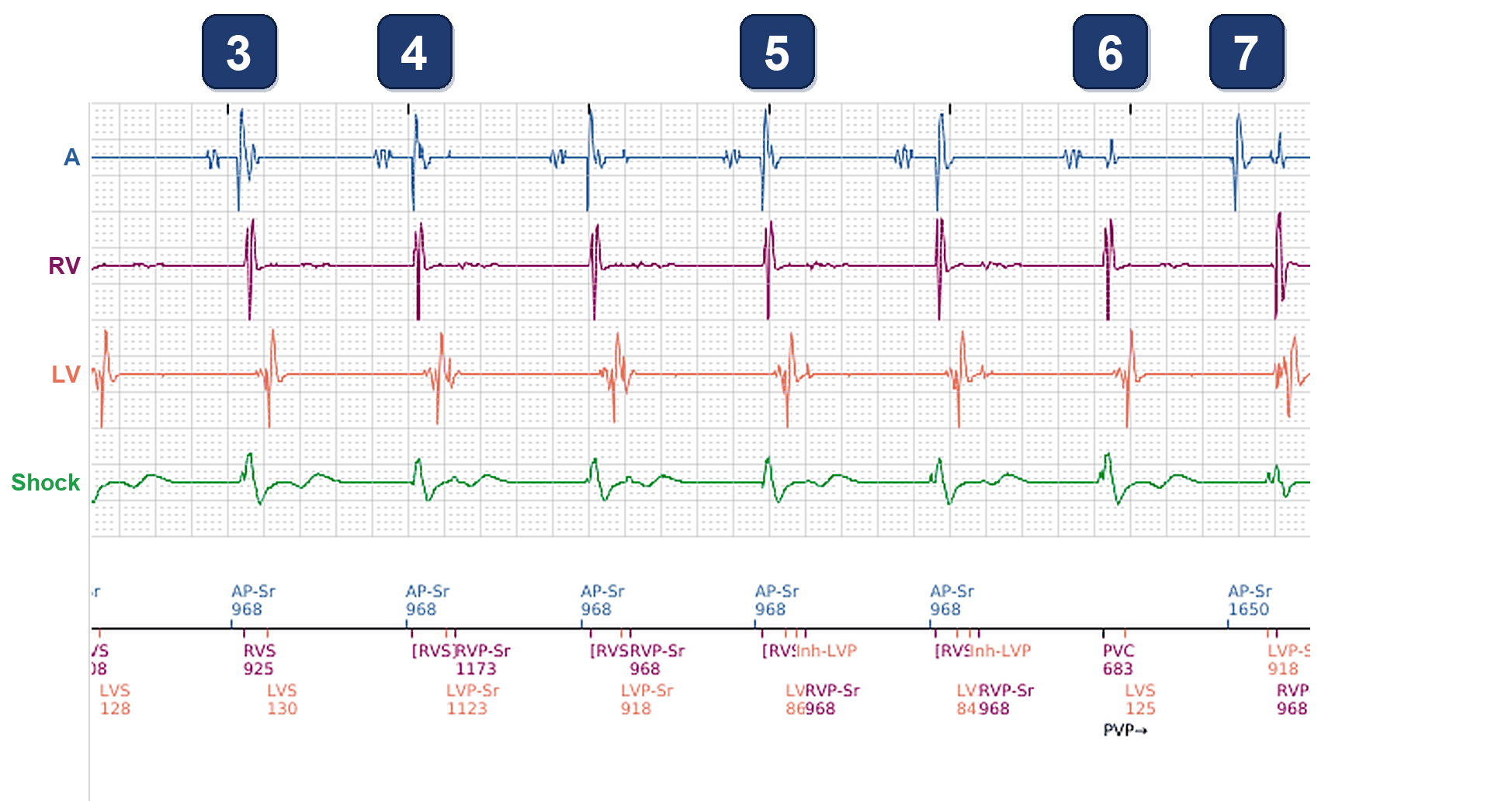 Boston Scientific CRT electrogram, segment 2/4 — CRT drop and low-amplitude atrial events