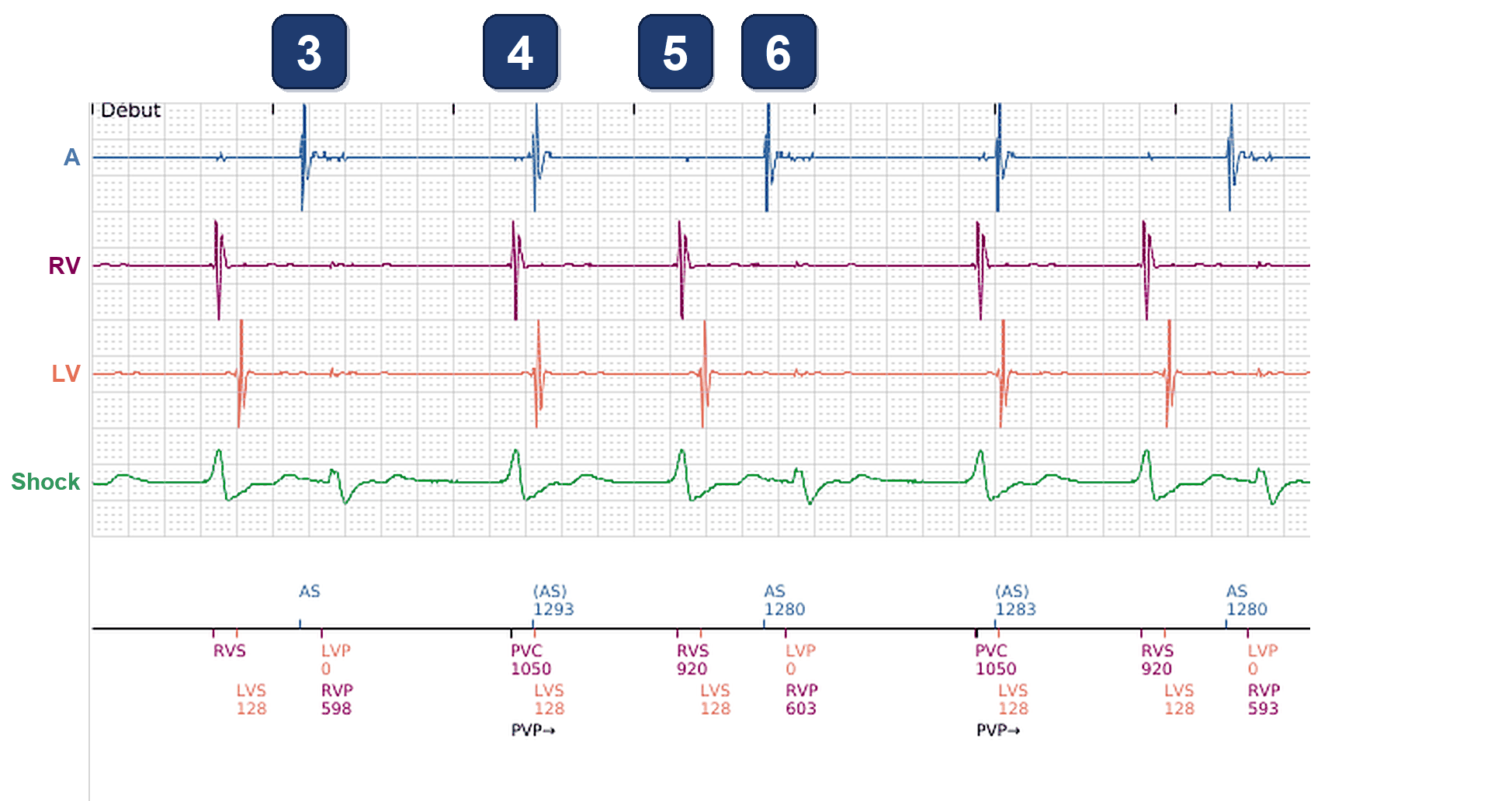 Boston Scientific CRT electrogram, segment 2/4 — CRT loss at rest with sinus bradycardia