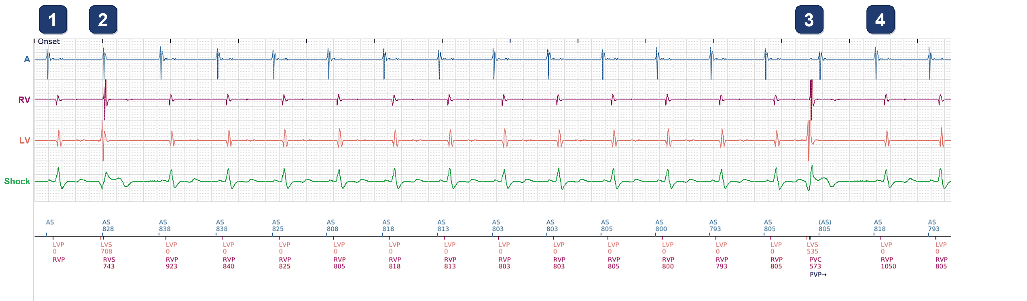 Boston Scientific CRT electrogram, segment 1/3 — CRT-D in sinus rhythm, BiV pacing 89%