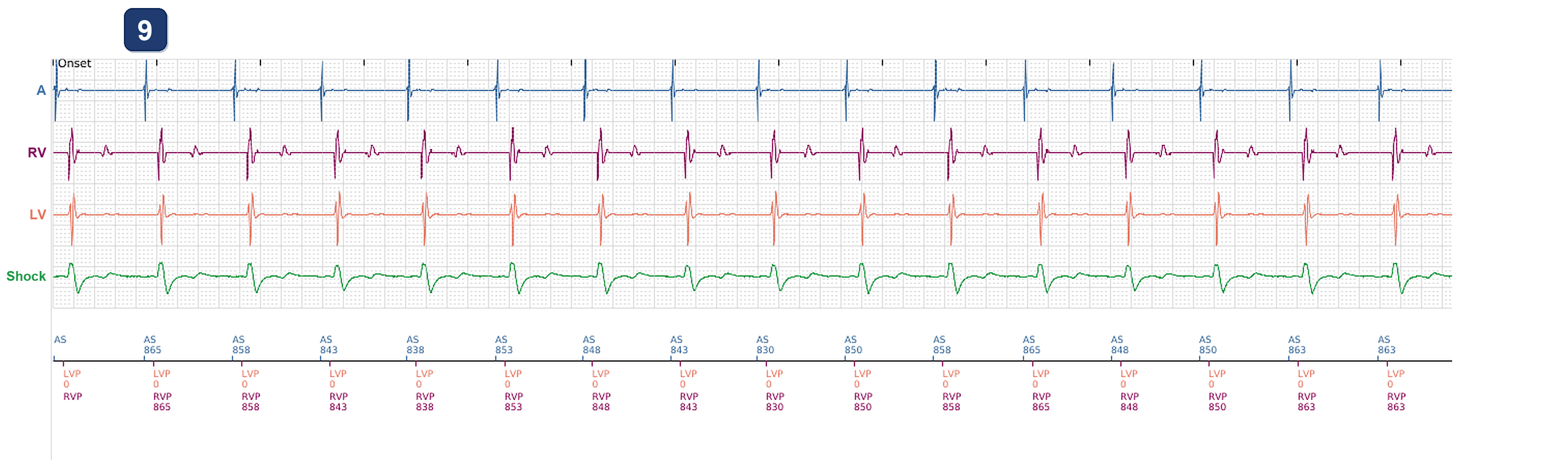 Boston Scientific CRT electrogram, segment 5/5 — CRT pacing alert at 57%, and 2 years later