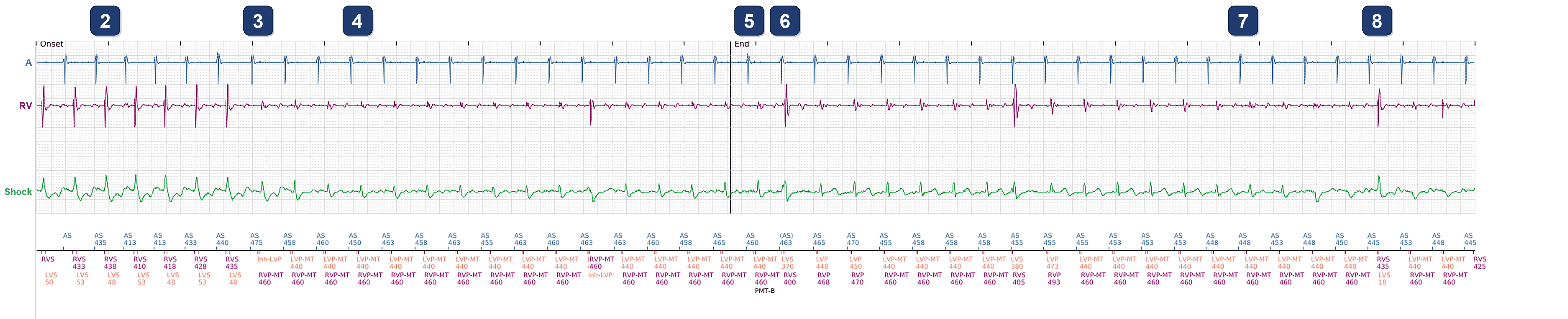 Boston Scientific CRT electrogram, segment 2/2 — A stored PMT episode at 130 min-1