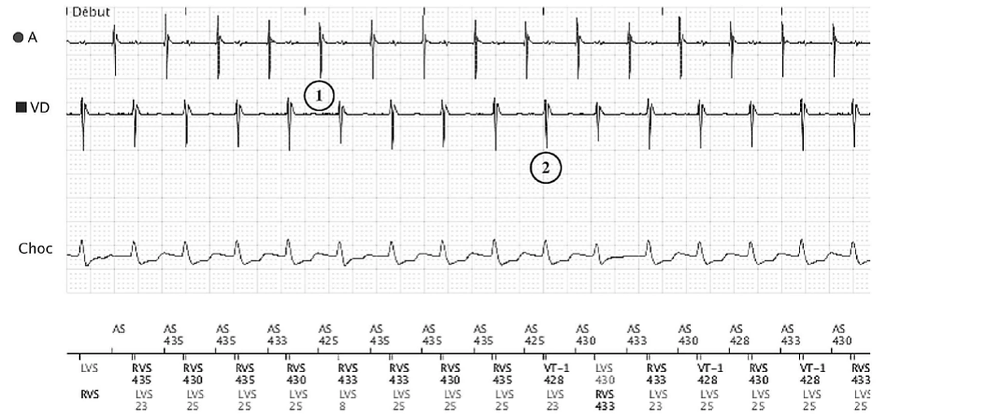Boston Scientific CRT electrogram, segment 2/3 — Exercise: sinus tachycardia in the VT-1 zone