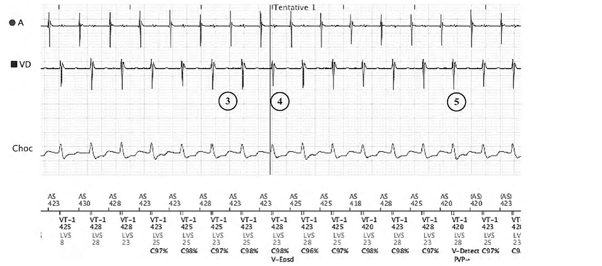 Boston Scientific CRT electrogram, segment 3/3 — Exercise: sinus tachycardia in the VT-1 zone