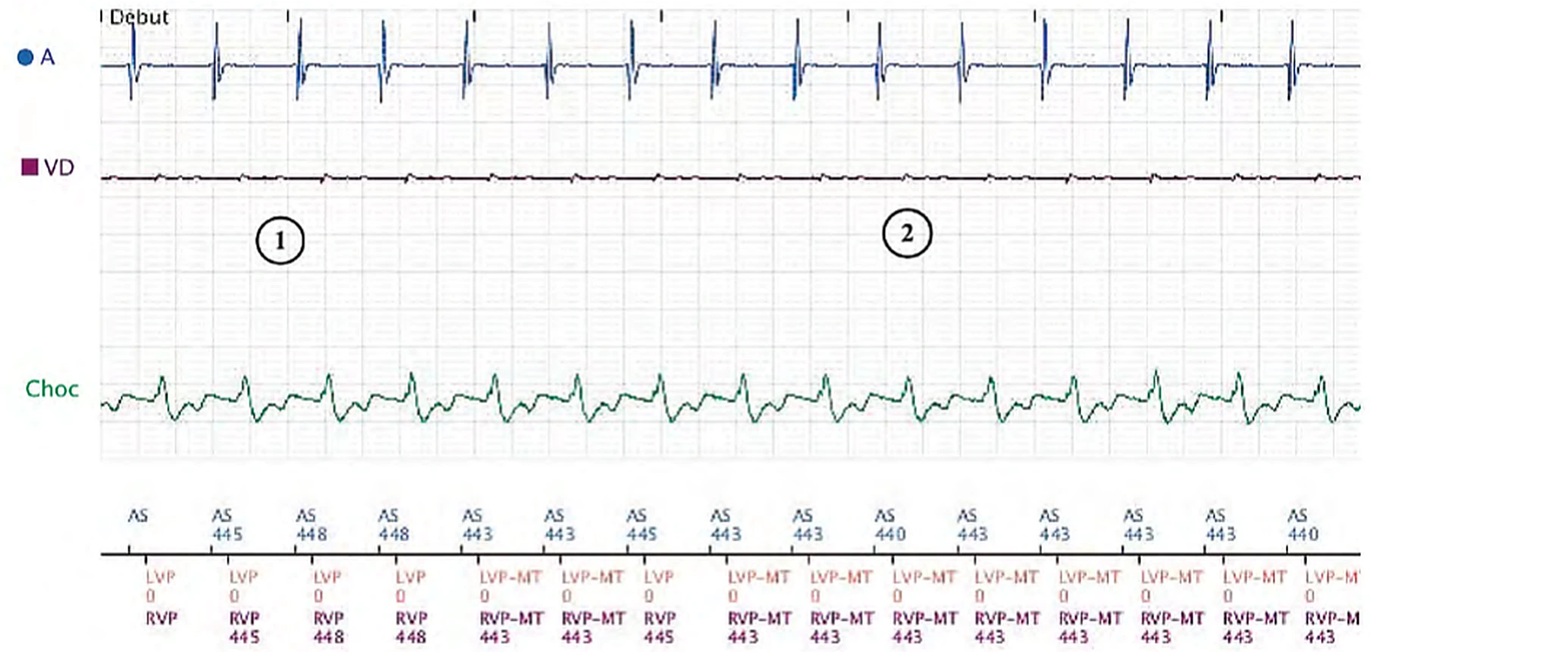 Boston Scientific CRT electrogram, segment 1/3 — Exercise, anti-PMT algorithm and long PR