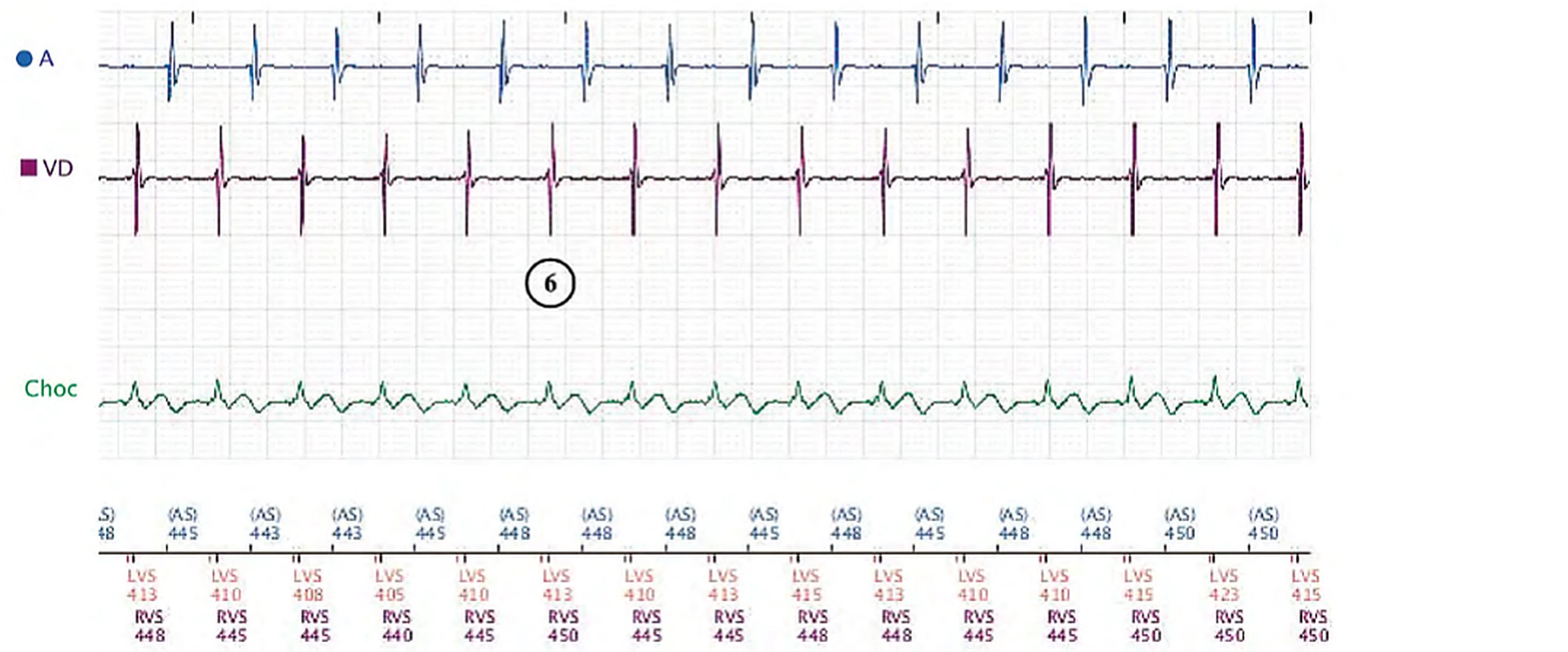 Boston Scientific CRT electrogram, segment 3/3 — Exercise, anti-PMT algorithm and long PR