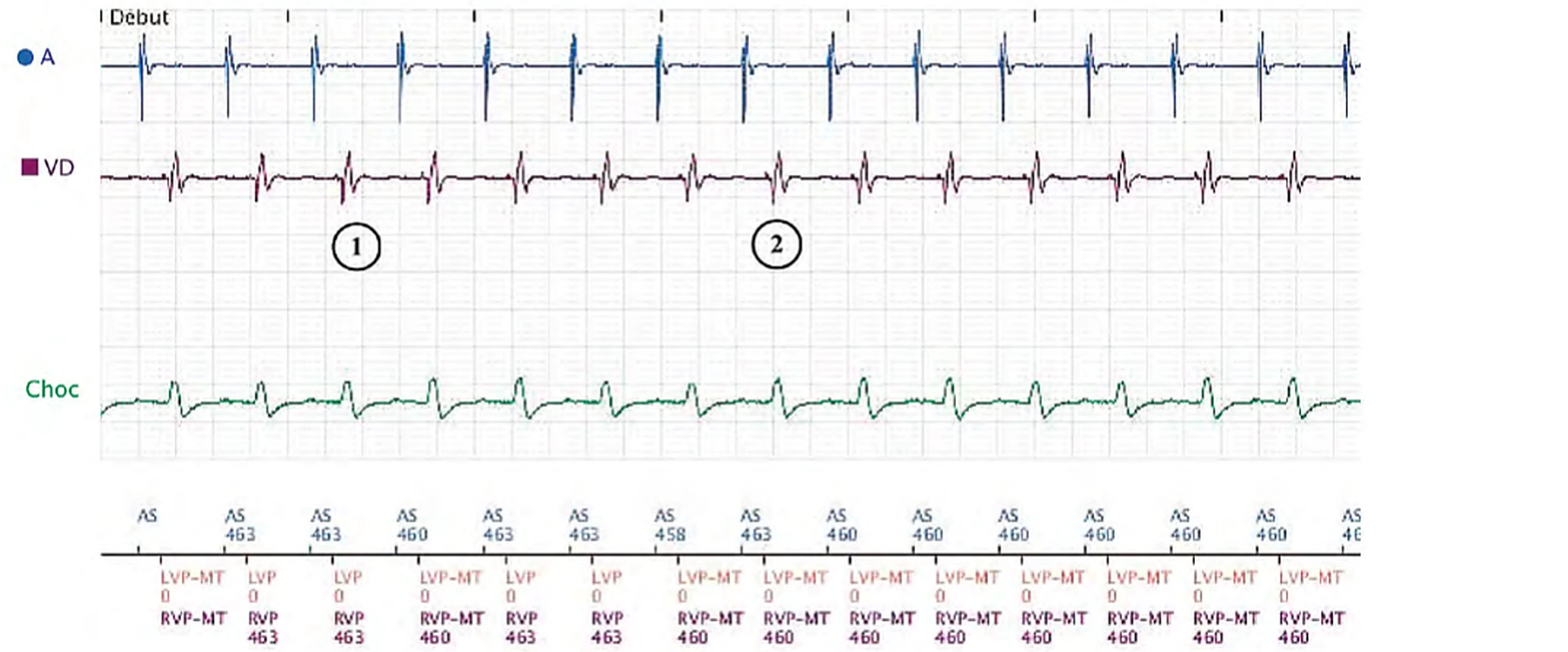 Boston Scientific CRT electrogram, segment 1/3 — Exercise, anti-PMT algorithm and LV sensing
