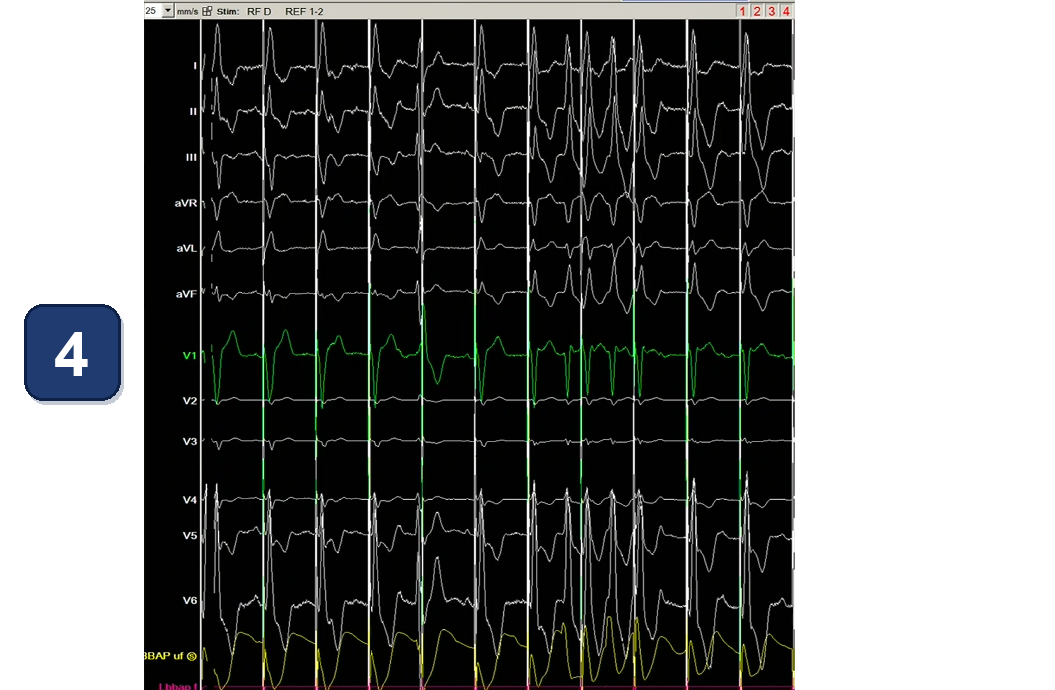 Boston Scientific CRT electrogram, segment 4/13 — CRT with a dual chamber pacemaker using LBBAP