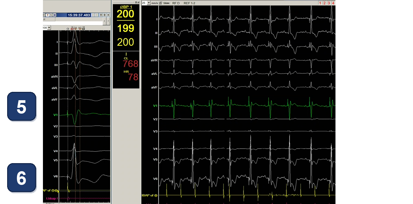 Boston Scientific CRT electrogram, segment 5/13 — CRT with a dual chamber pacemaker using LBBAP