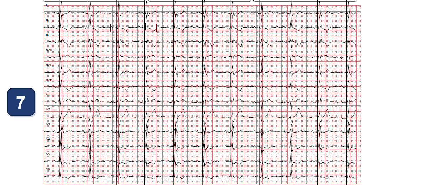 Boston Scientific CRT electrogram, segment 6/13 — CRT with a dual chamber pacemaker using LBBAP