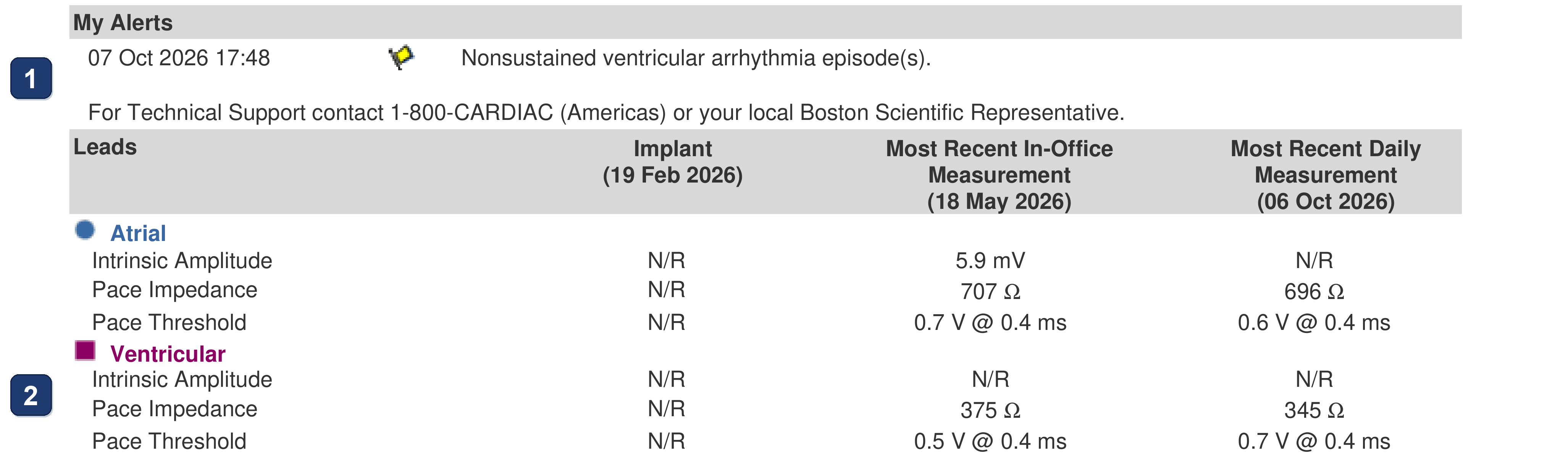 Boston Scientific CRT electrogram, segment 7/13 — CRT with a dual chamber pacemaker using LBBAP