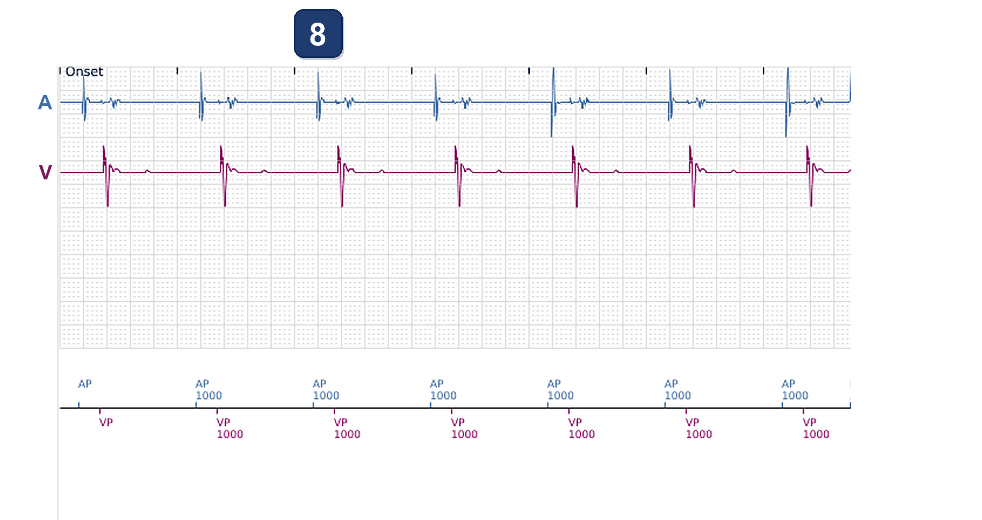 Boston Scientific CRT electrogram, segment 11/13 — CRT with a dual chamber pacemaker using LBBAP