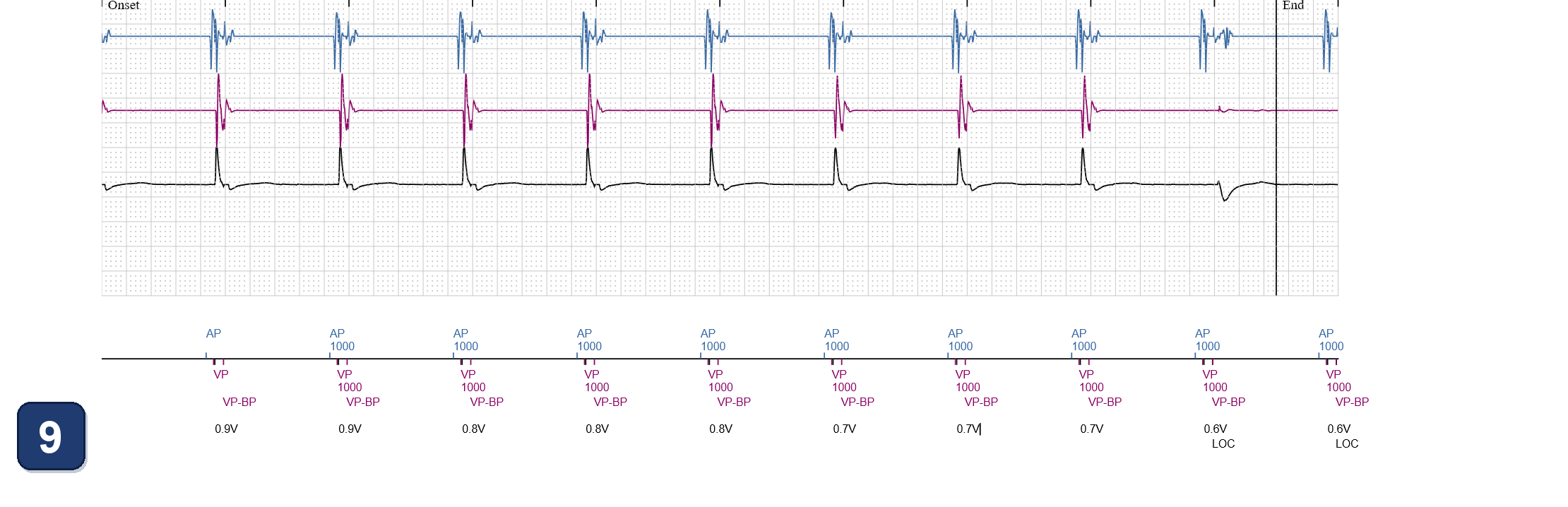 Boston Scientific CRT electrogram, segment 12/13 — CRT with a dual chamber pacemaker using LBBAP