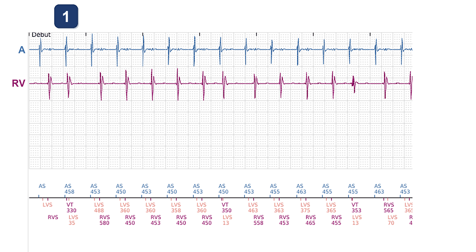 Boston Scientific CRT electrogram, segment 1/12 — Tachycardia while dancing: what the CRT-P and the S-ICD saw