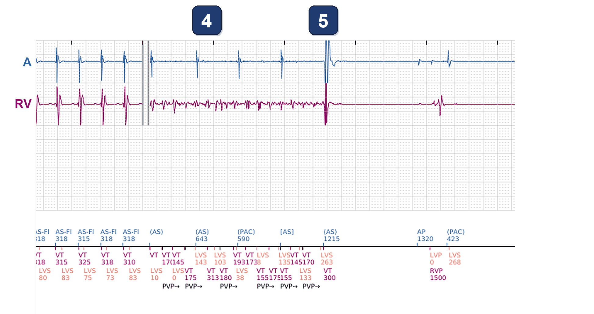 Boston Scientific CRT electrogram, segment 3/12 — Tachycardia while dancing: what the CRT-P and the S-ICD saw