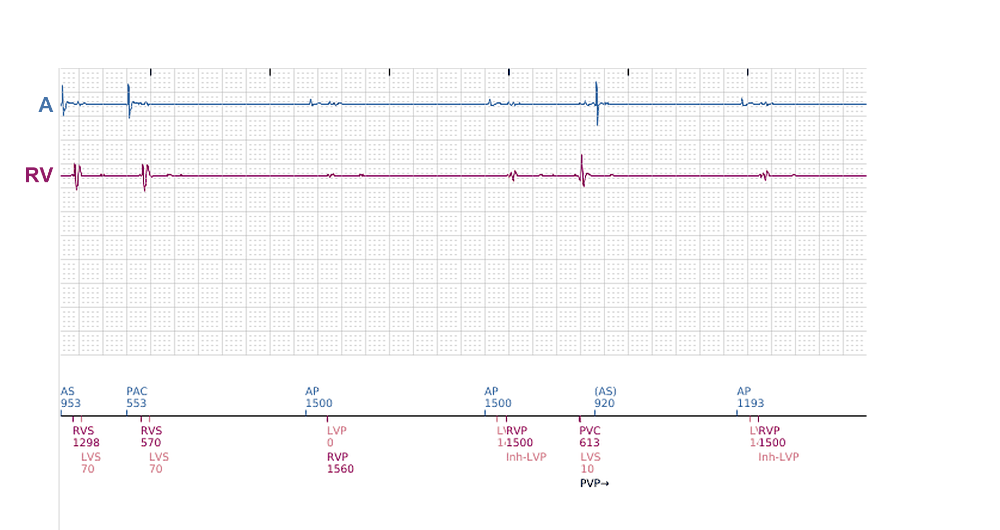 Boston Scientific CRT electrogram, segment 4/12 — Tachycardia while dancing: what the CRT-P and the S-ICD saw