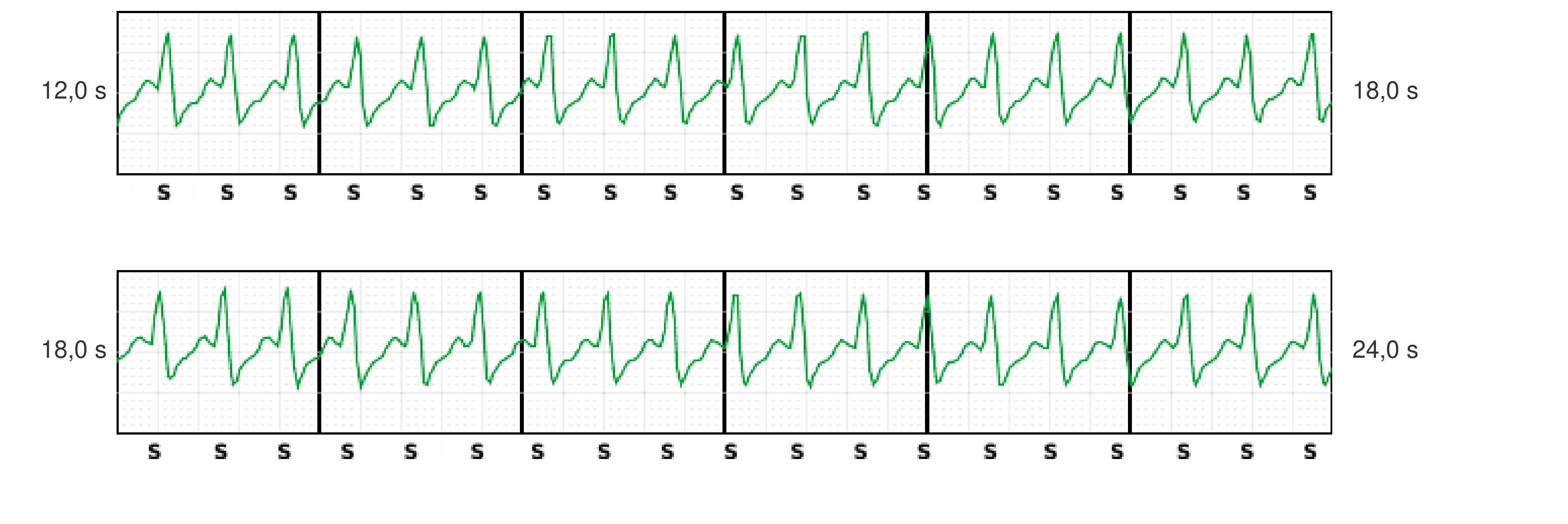 Boston Scientific CRT electrogram, segment 7/12 — Tachycardia while dancing: what the CRT-P and the S-ICD saw