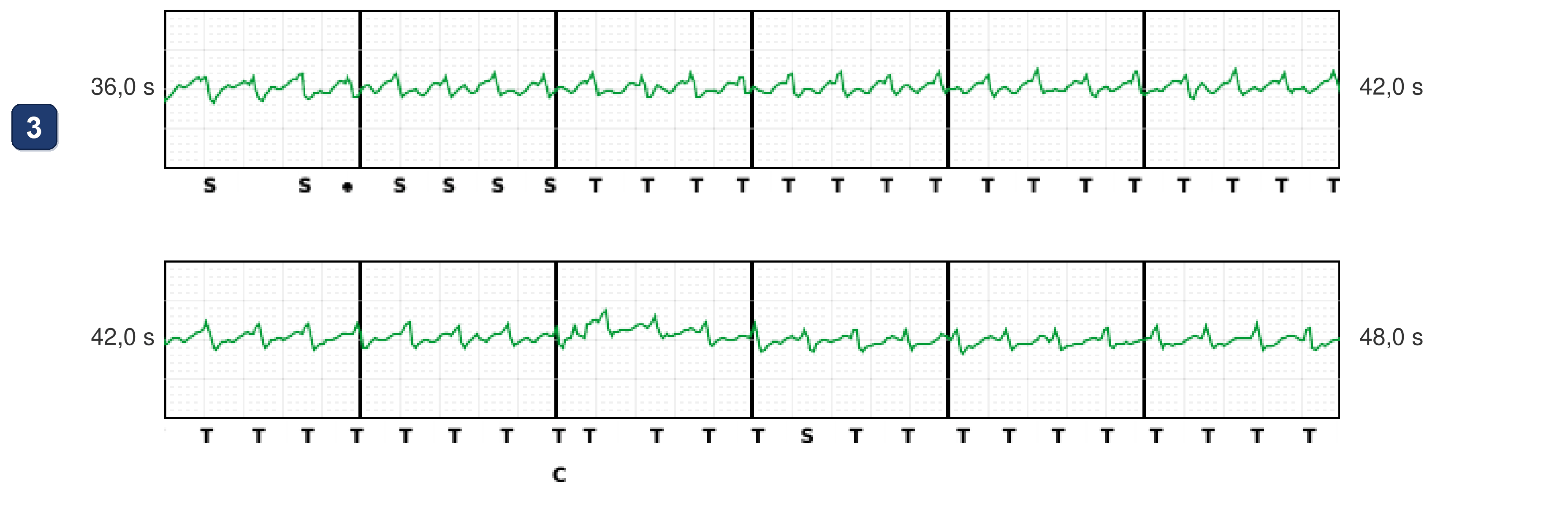 Boston Scientific CRT electrogram, segment 9/12 — Tachycardia while dancing: what the CRT-P and the S-ICD saw