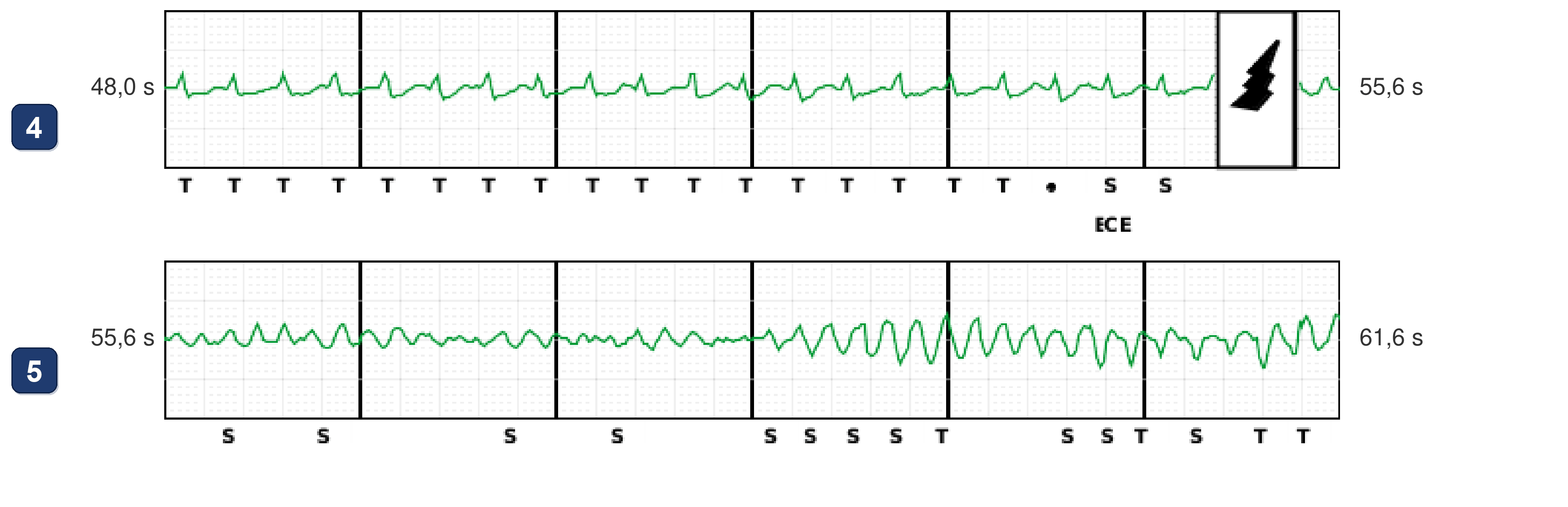 Boston Scientific CRT electrogram, segment 10/12 — Tachycardia while dancing: what the CRT-P and the S-ICD saw