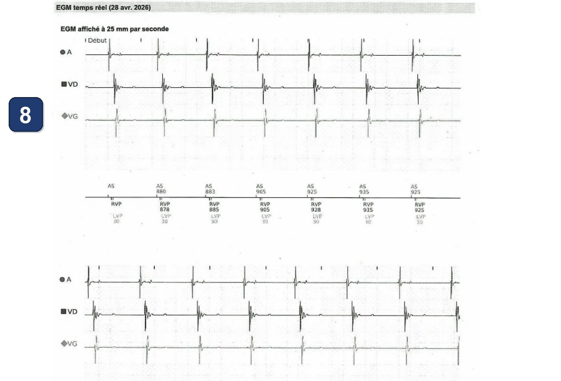 Boston Scientific CRT electrogram, segment 10/10 — LOT-CRT with a Boston CRT-P