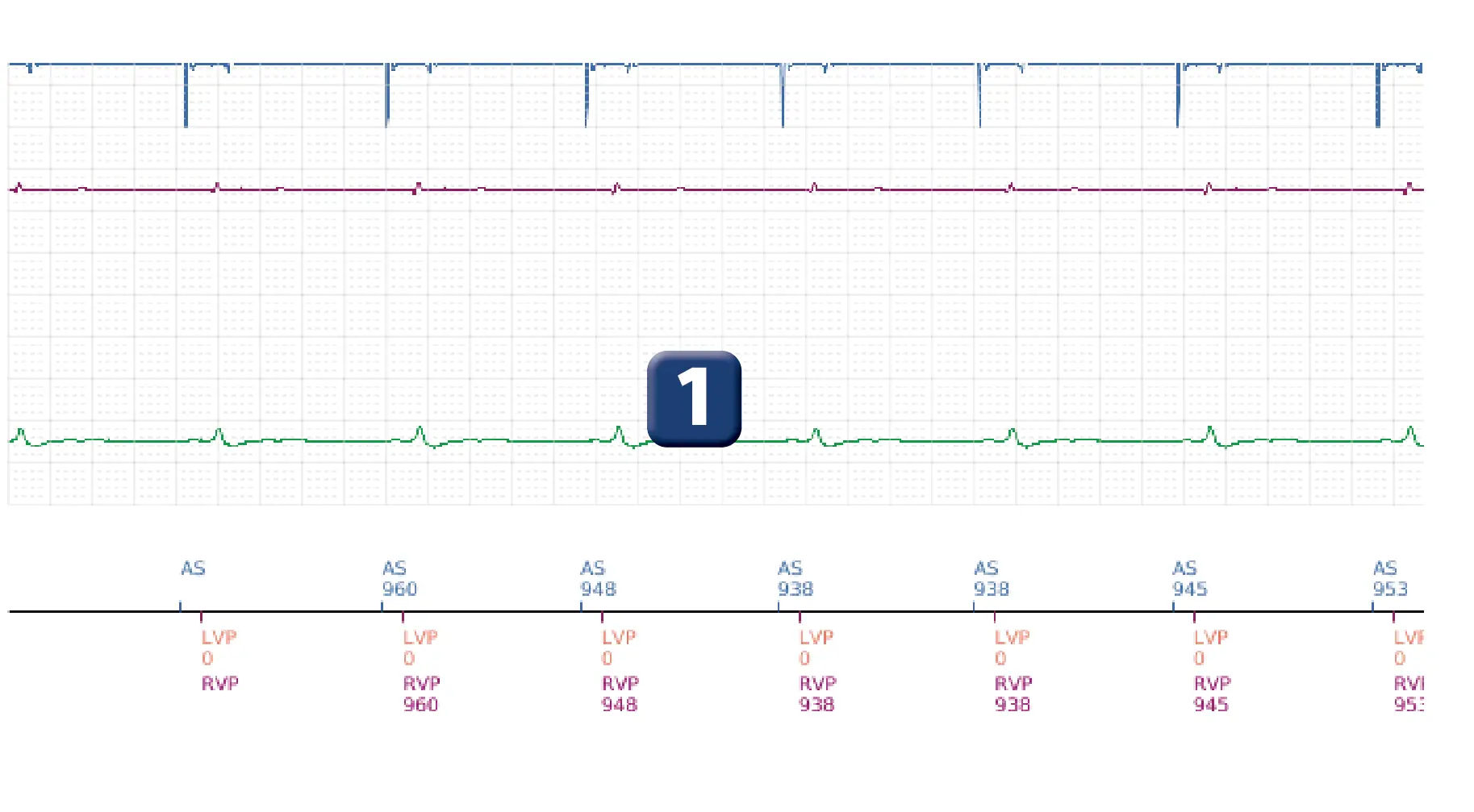 Boston Scientific ICD electrogram, segment 1 of 6 — Detection and treatment of a VF episode